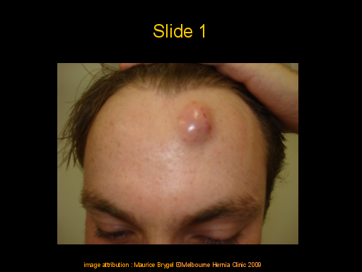 infected sebaceous cyst in scalp