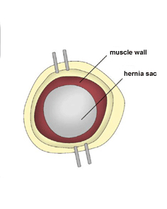 Incisional Hernia. Figure 3. Melbourne Hernia Clinic.