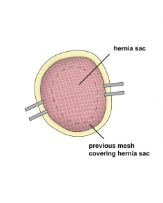 Incisional Hernia. Figure 3. Melbourne Hernia Clinic.