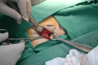This shows a femoral hernia being operated on and a mesh plug being inserted into the femoral ring.