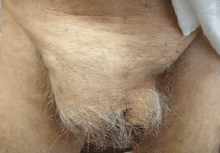 This is a larger hernia in an elderly man descending into the scrotum. This hernia is in danger of strangulation.