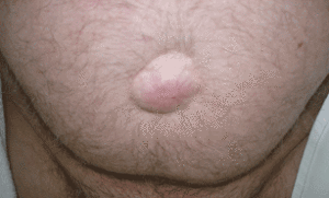 Umbilical