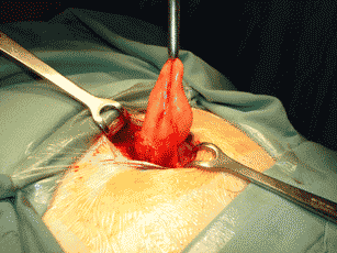 Typical fatty inguinal hernia at operation. The skin is being retracted for better exposure. The plastic tubing is retracting the cord which contains the blood vessels to the testis and the vas which conduct the sperm. It is important not to damage these structures. The surgeon can either cut out this lump or push it back in.